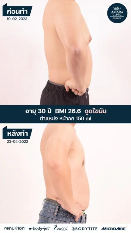 liposuction men belly berfore and after