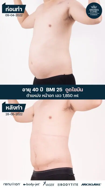 liposuction mens belly