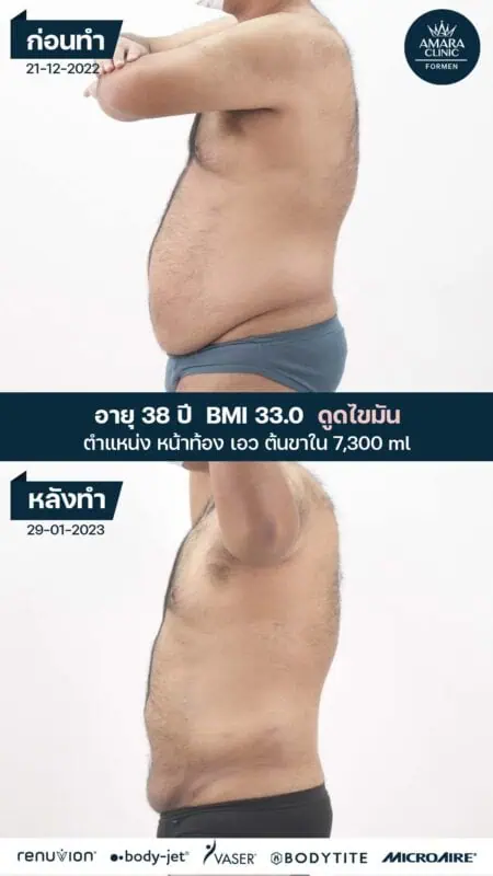 liposuction mens belly thailand