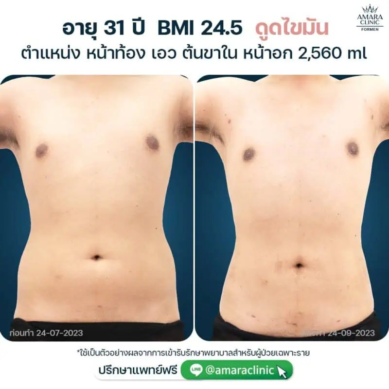 Vaser liposuction in Bangkok