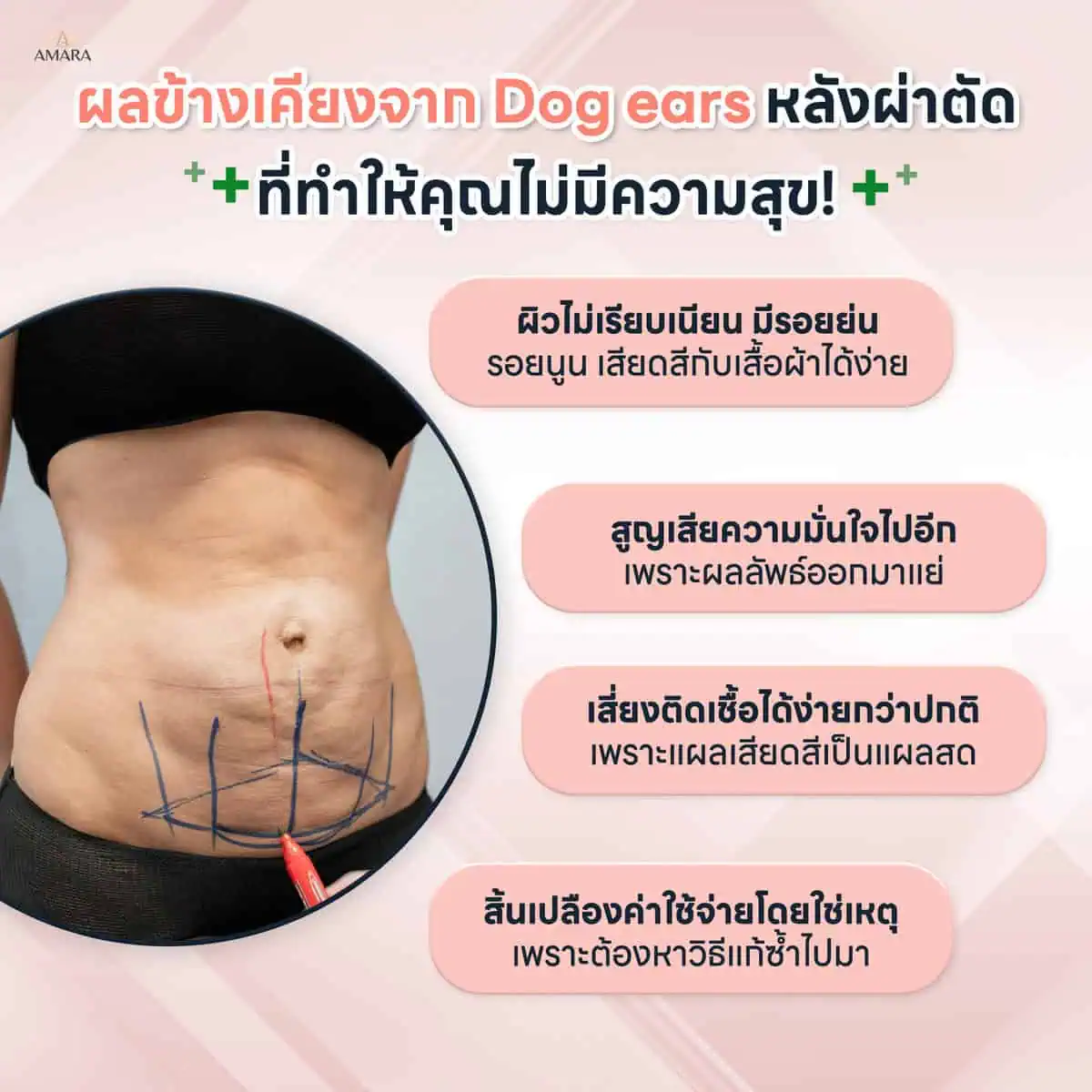 Dog ears หลังตัดหนังหน้าท้อง ผลเสีย