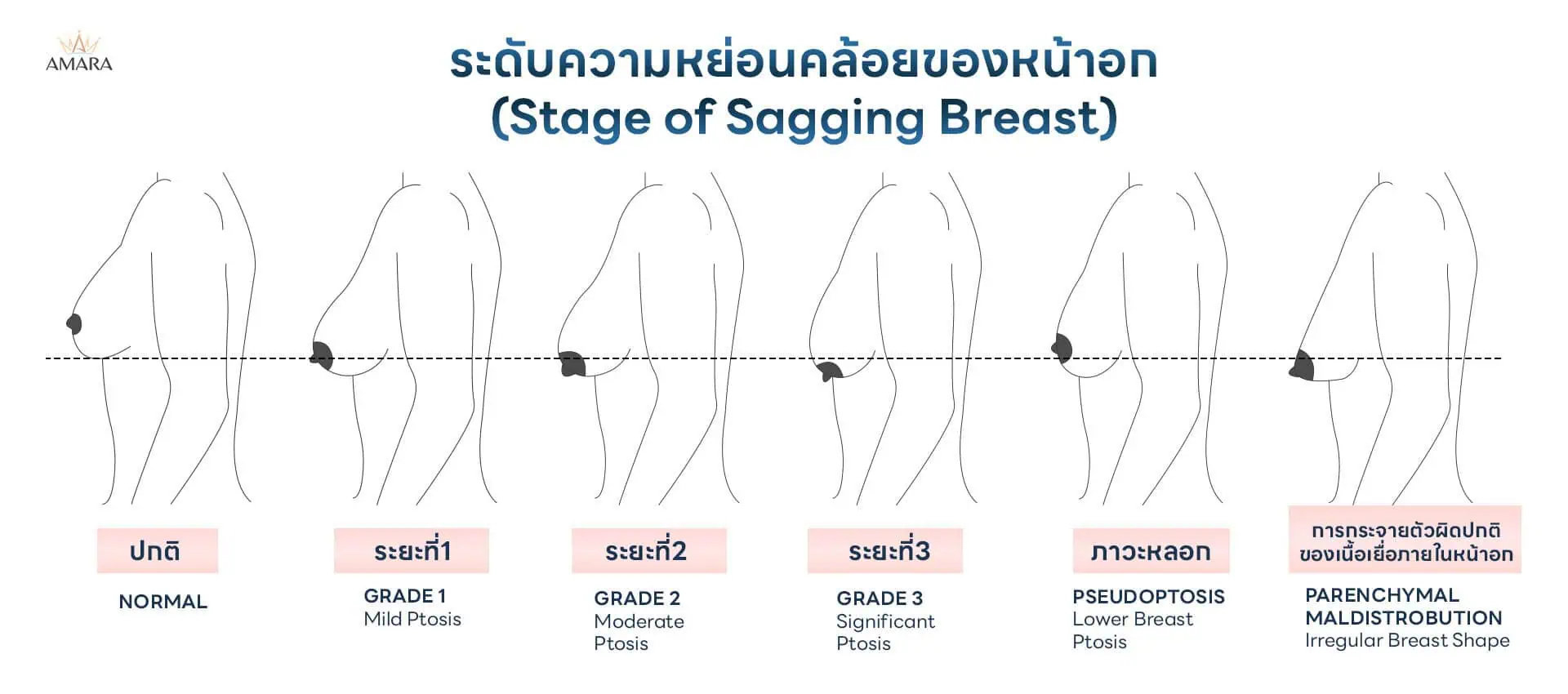 หน้าอกหย่อนคล้อย ระดับ