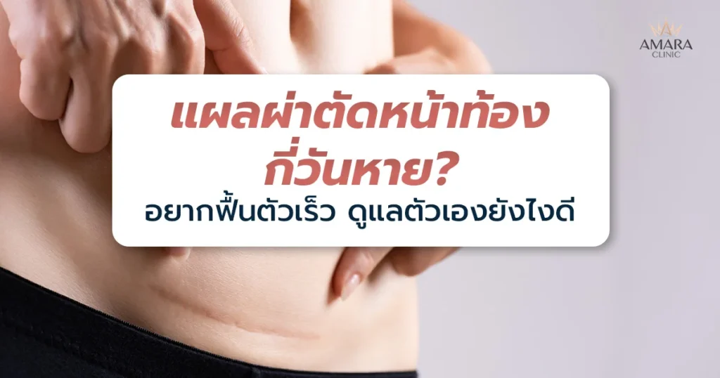 แผลผ่าตัดหน้าท้องกี่วันหาย