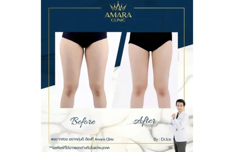 รีวิวลดเซลลูไลท์