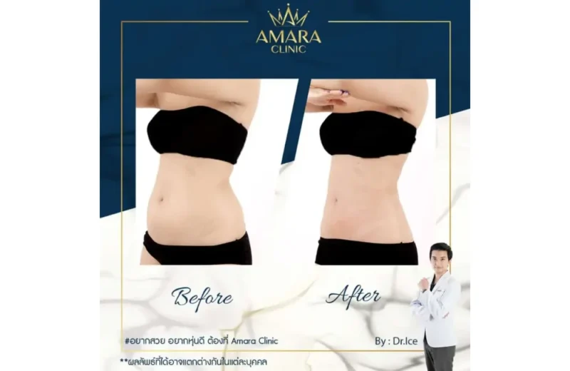 รีวิวลดเซลลูไลท์